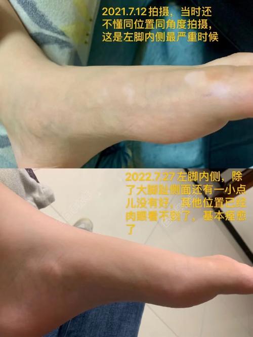 萎缩性白斑能治愈吗?:萎缩性白斑能治愈吗?service=bdbox